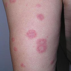 Erythema multiforme