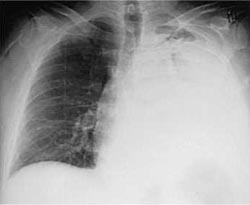 Bacterial pneumonia