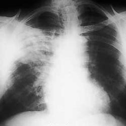 Bacterial pneumonia