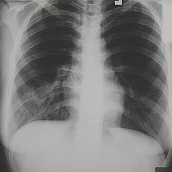 Pneumonia - Legionella pneumophila