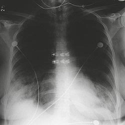 Pneumonia – Mycoplasma pneumoniae