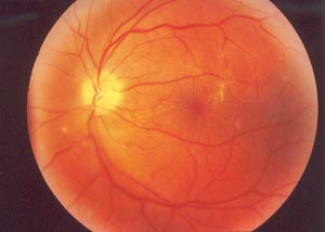 Fundus OL