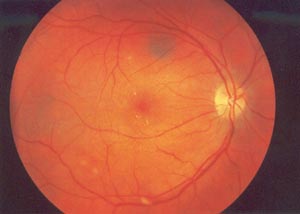 Fundus OP