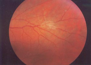 Fundus OL