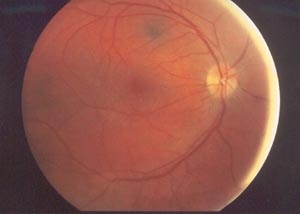 Fundus OP