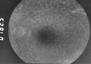 Fundus OL