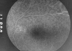 Fundus OL