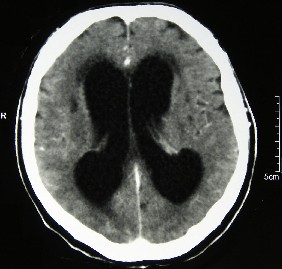 Obstructive Hydrocephalus