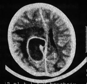 Cerebral Abscess