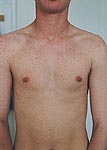 Morbiliformn exantm