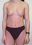 Skarlatiniformn exantm