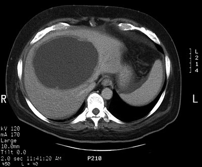 Jatern absces