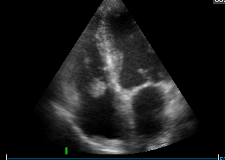 Echokardiogram
