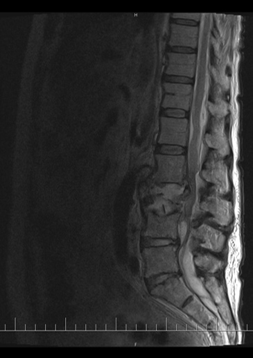 MRI L ptee - T2W zobrazen