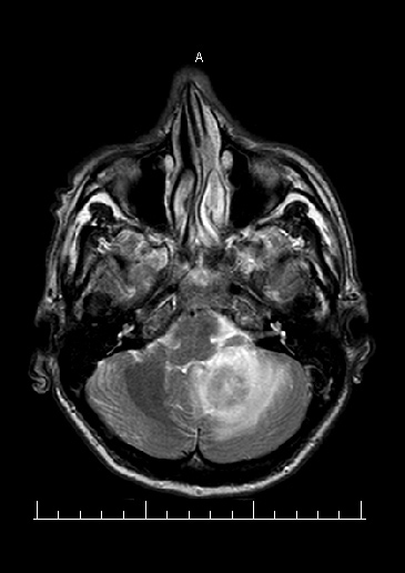 MRI mozku - T2W zobrazen