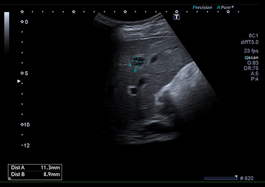 Sonografie bicha