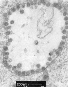 Human pneumonia-associated coronavirus