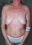 Morbilliform rash