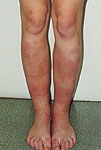 Erythema nodosum