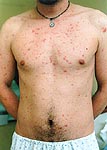 Primary HIV infection