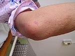 Erythema multiforme