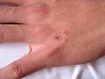 Erythema multiforme