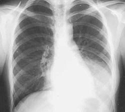 Bacterial pneumonia