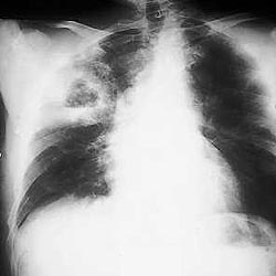 Bacterial pneumonia