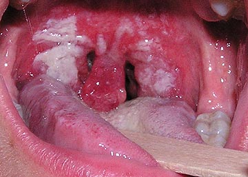 White Bumps on Tongue, Back, Tip, Side, Under Pictures ...