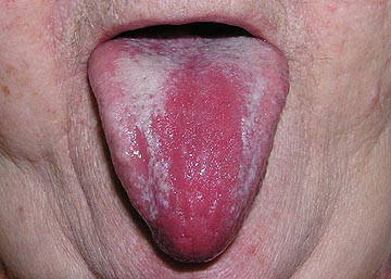 Scarlet fever: Strawberry tongue, other symptoms, & treatment