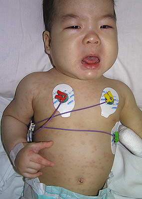 Kawasakiho syndrom