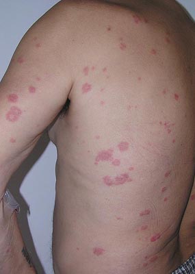 Erythema multiforme