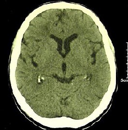 Normal CT Scan