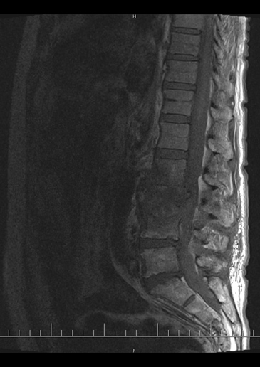 MRI L ptee - T1W zobrazen