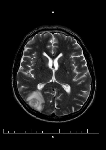 MRI mozku - T2W zobrazen