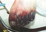 Gangrene of feet