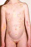 Secondary infection of chickenpox - impetigo