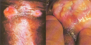 Granuloma inguinale