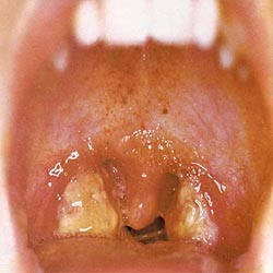 Inflammed tonsils with exudate
