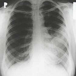 Pneumonia - Chlamydophila pneumoniae