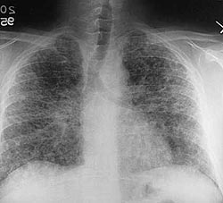 Chickenpox pneumonia