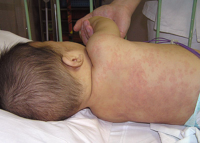 Kawasakiho syndrom