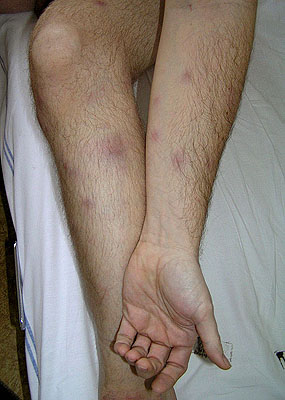 Erythema nodosum