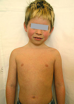 Megalerythema infectiosum