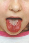 Strawberry tongue